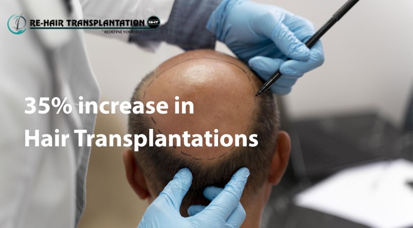 Re-Hair Transplantation Banner